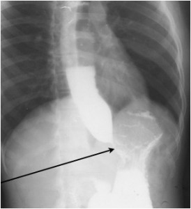 achalasia1326757380348