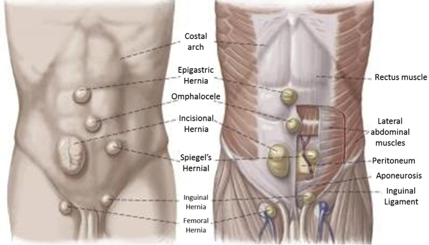 hernia33